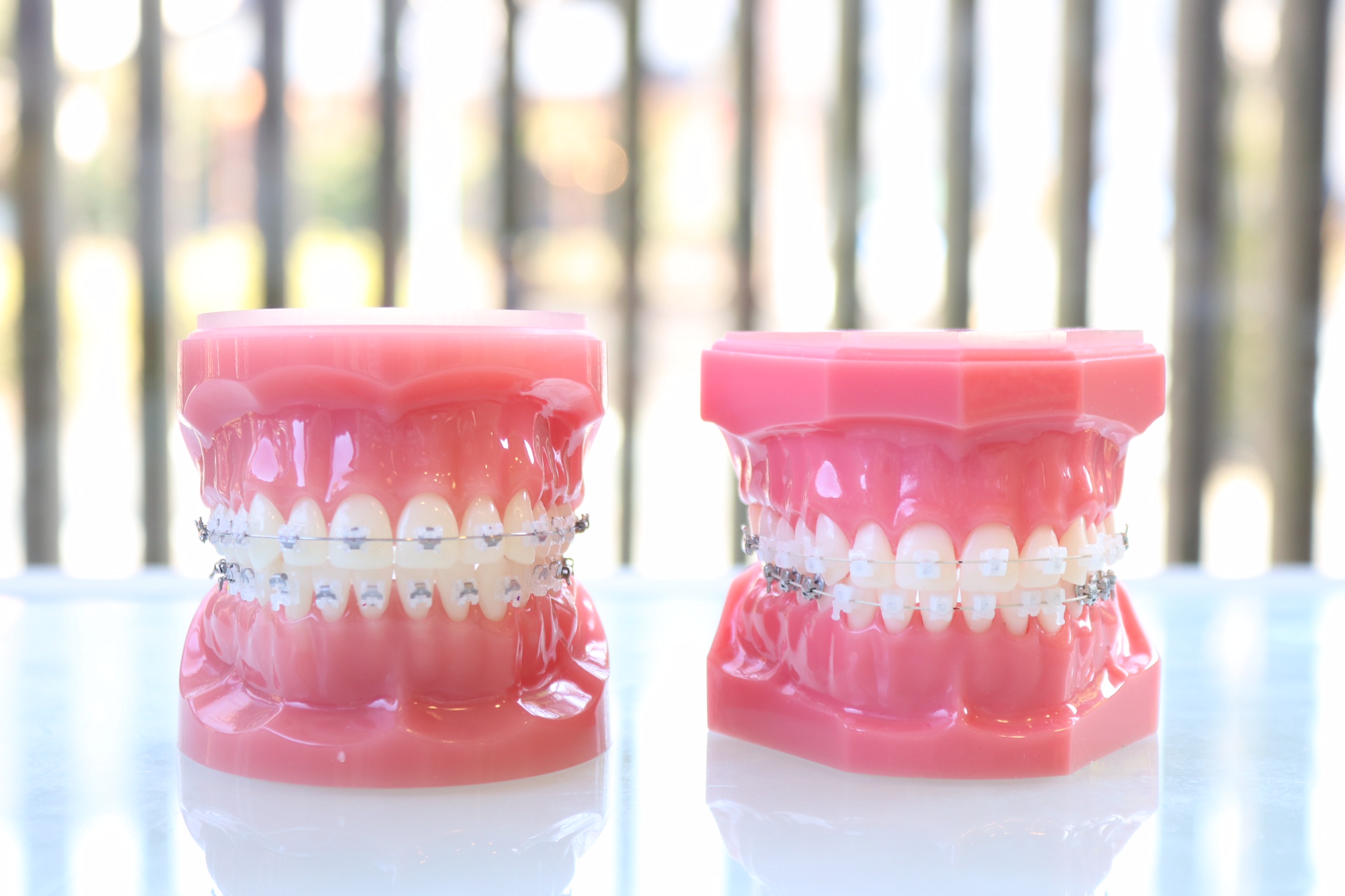 ワイヤー矯正にはいくつか種類がある？矯正法・装置の違いを紹介 | 中