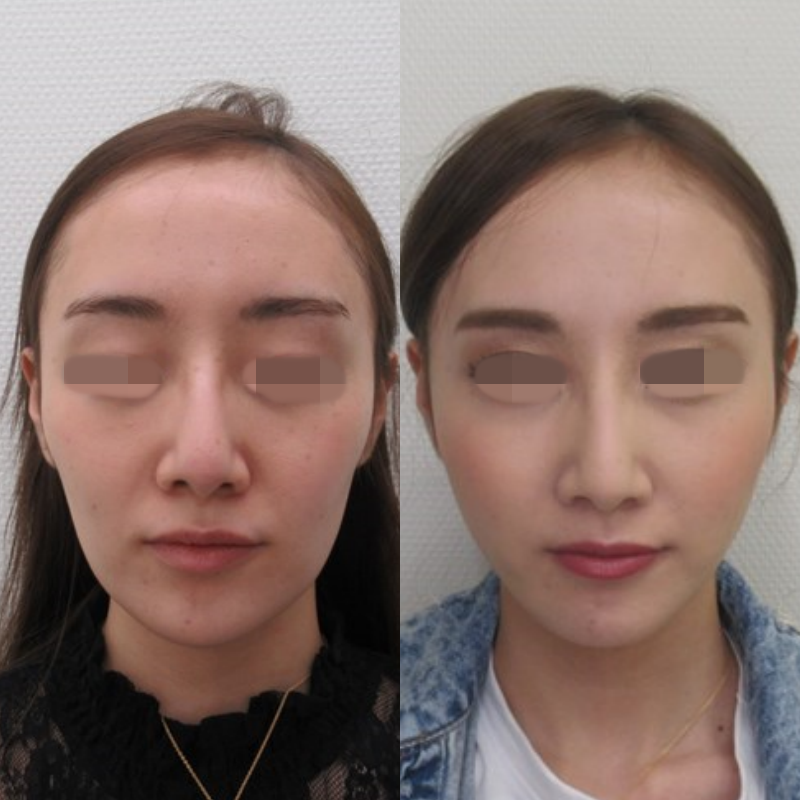 コラーゲンリフト一週間経過。｜画像・費用｜美容整形・美容外科のTA