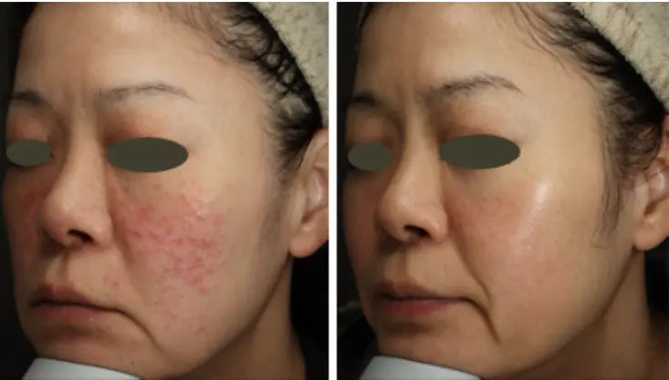 アゼライン酸なら池袋駅前のだ皮膚科へ｜ニキビ・ニキビ跡、赤ら顔、肝