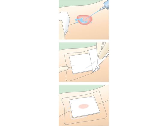 アルケア デルマエイド 2号 100枚入 11982 通販【フォレストウェイ】