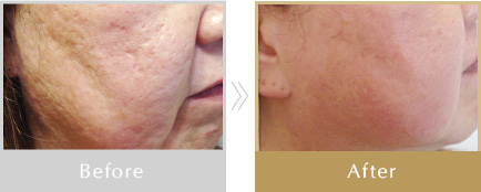 リベルハーブピーリング | トータルビューティーサロン「ヴィアージュ