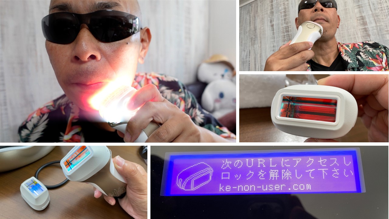 ケノン史上最高出力のストロング2カートリッジでヒゲ脱毛に初挑戦