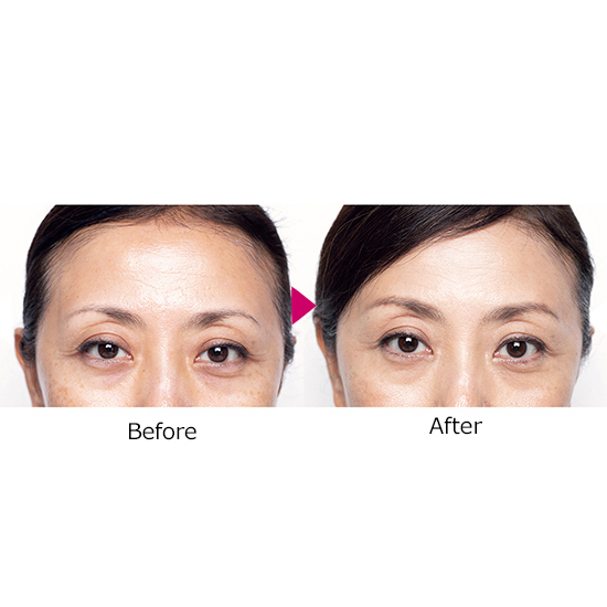 定期購入】[iGS4000]セレST限定セット超抗酸化サプリ&ジェル