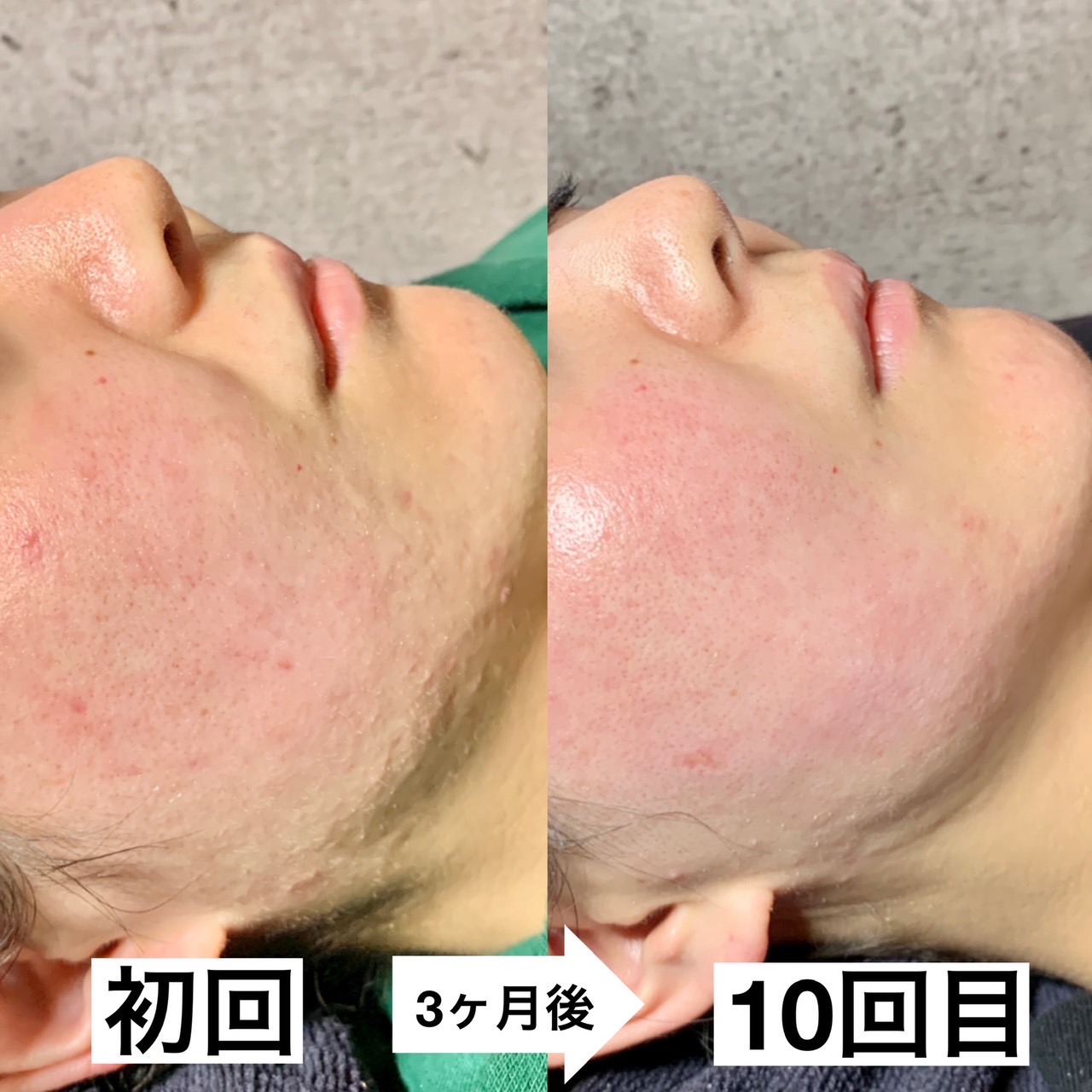 姫路市でハーブピーリングを受けるならここ！