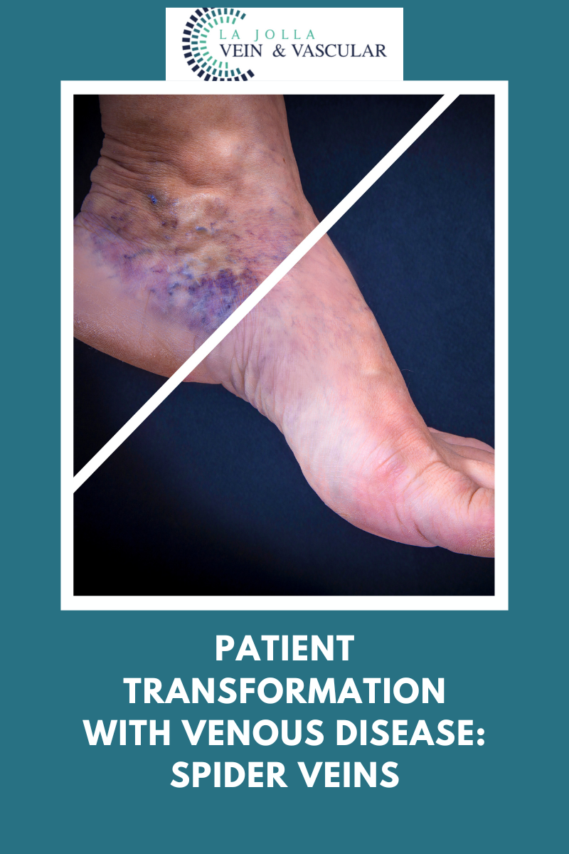 Spider Vein & Vascular Treatment