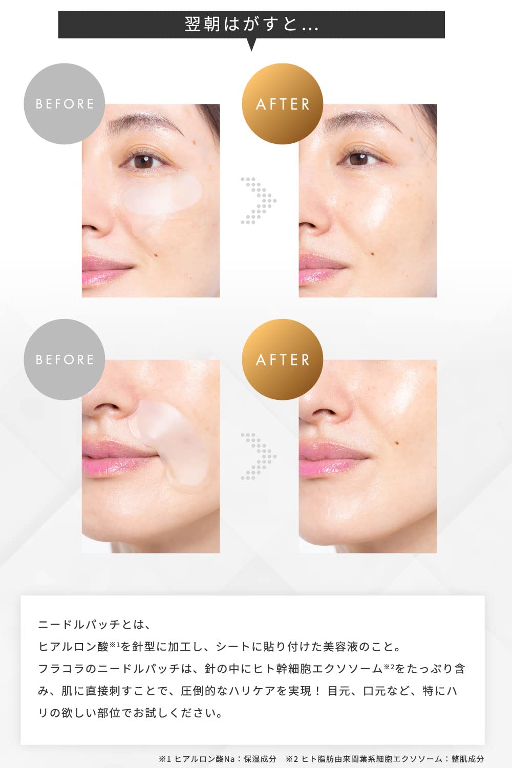 Amazon.co.jp: ○HITOKAN マイクロニードルパッチEX : ビューティー