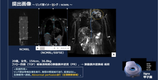 非造影MRリンパ管イメージングへの挑戦！！！ | MRIfan.net