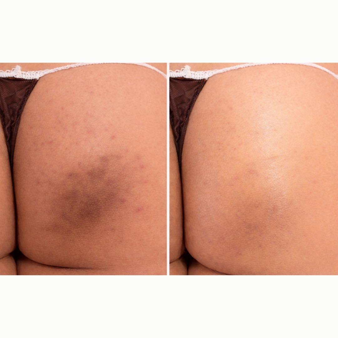 体】剥離ありハーブピーリング【1回分】 - メルカリ