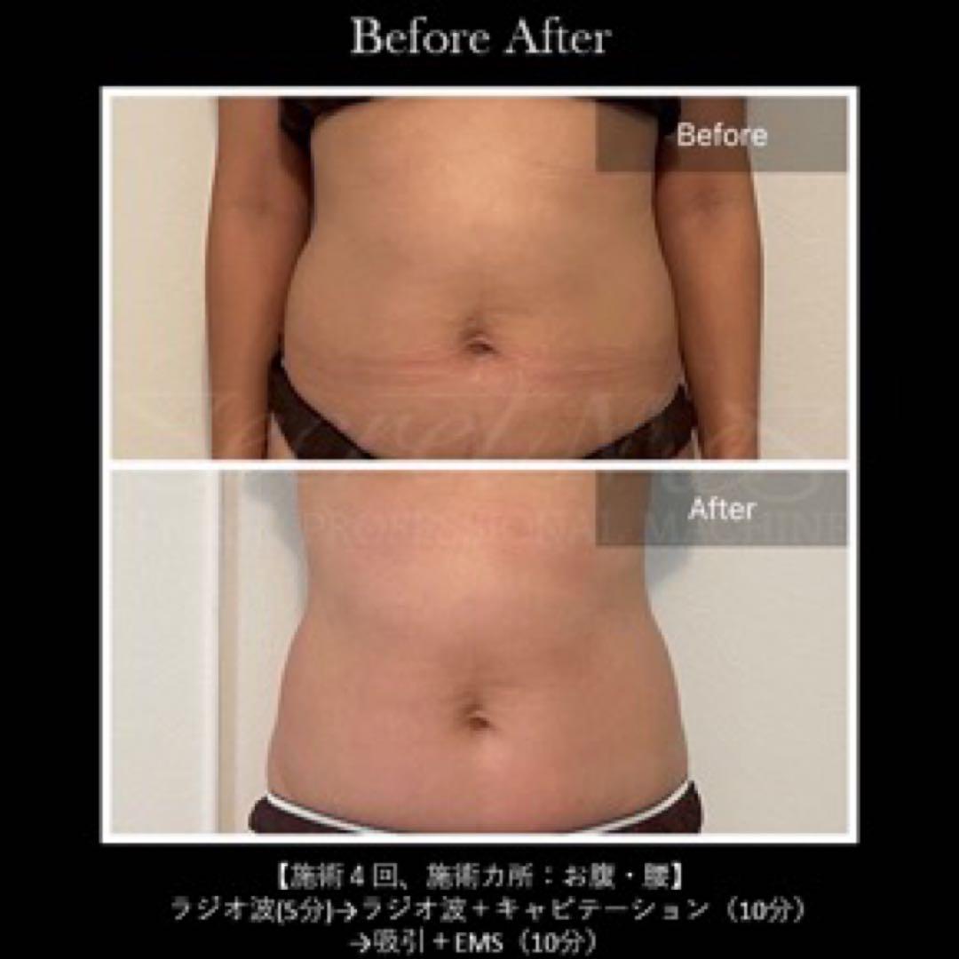 美品ポスター付　多機能痩身美顔　シークレットメス　セルフ用　本体のみワゴン別売